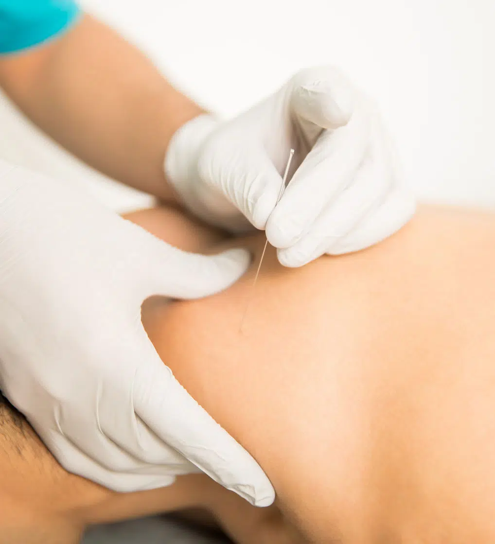 dry needling physiotherapy